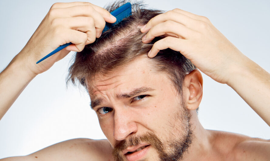 Hair Loss (Alopecia) in Men: Causes, Treatments, and Self-Care