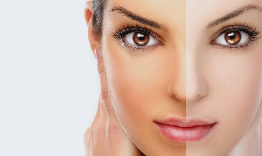 Brighten your Face with Skin Lightening Treatment