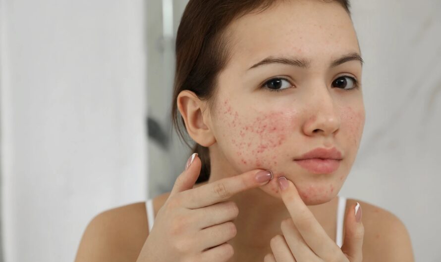 Acne: Causes and Best Acne Treatment in Mumbai & Pune