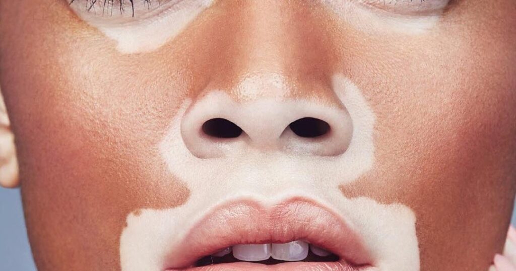 Acrofacial Vitiligo