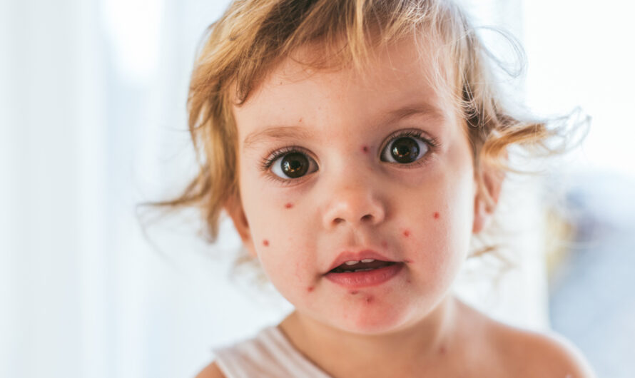 Common Skin Infections in Children Demystified