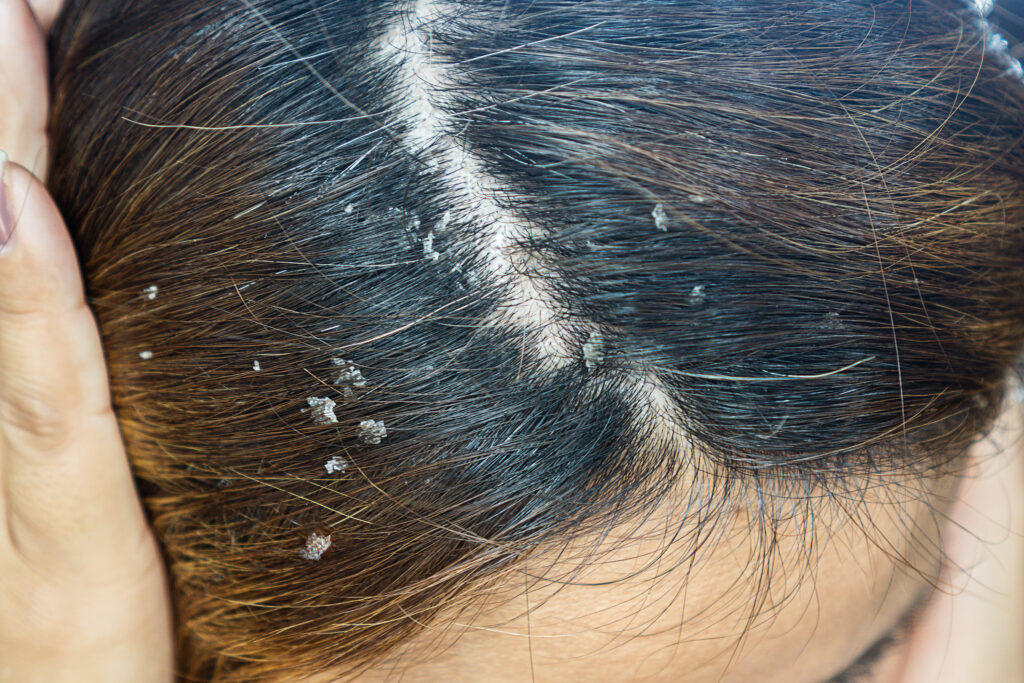 Dandruff (Seborrheic Dermatitis)