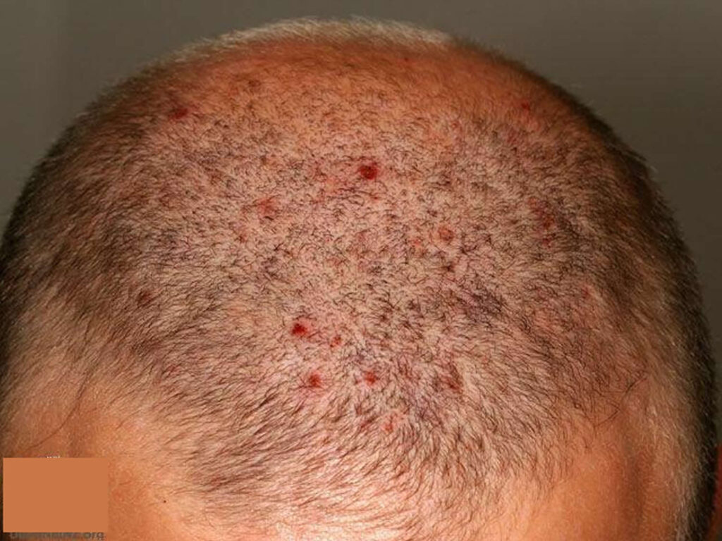 Folliculitis