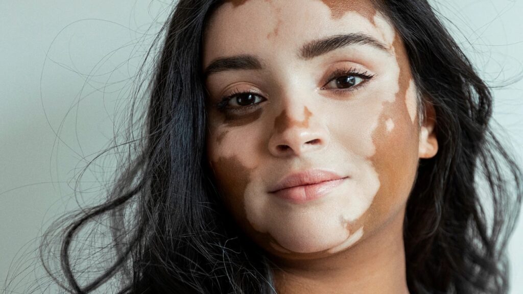 Generalized Vitiligo