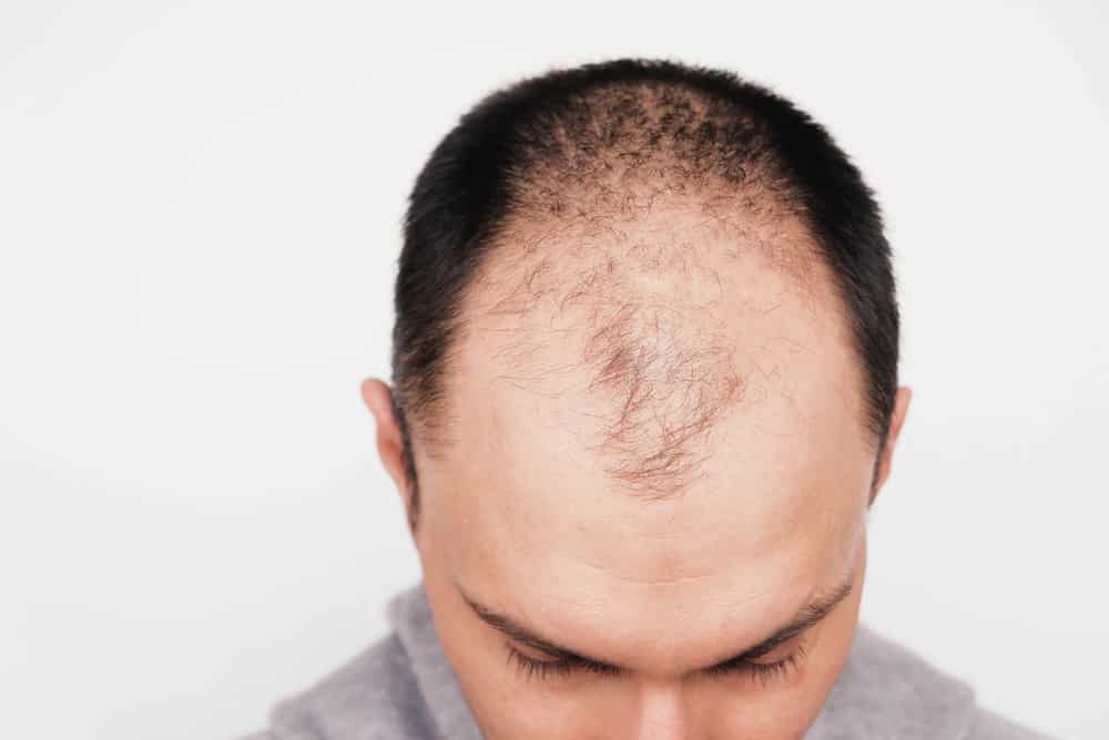 Genetics (Androgenetic Alopecia)