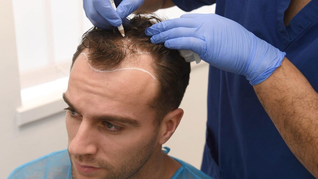 Hair Transplant Surgery