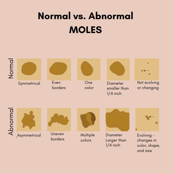 Normal vs. Abnormal Moles