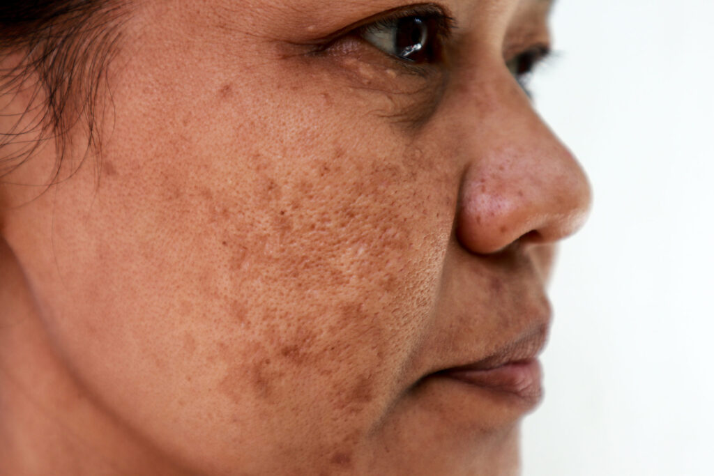 Post-Inflammatory Hyperpigmentation (PIH)