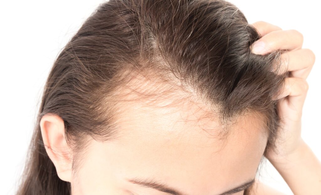 Unexplained hair thinning