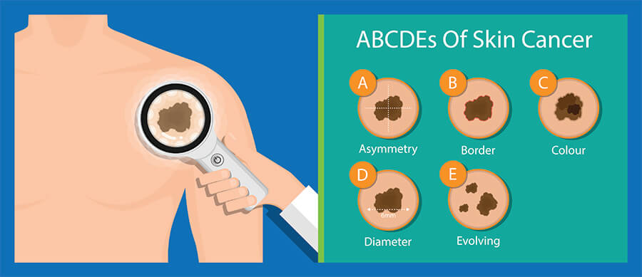 Early Detection Strategies for Skin Cancer bt Skinzone Clinic