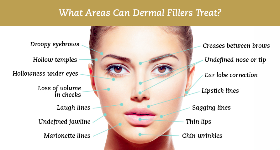 Filler Treatment Areas