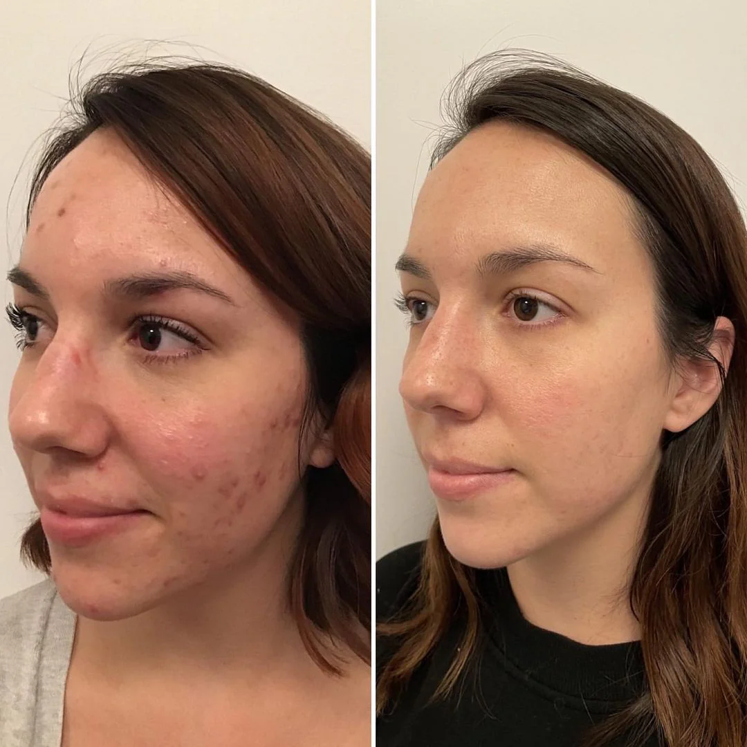 Treatment Process: Before After HydraFacial vs. Medifacial