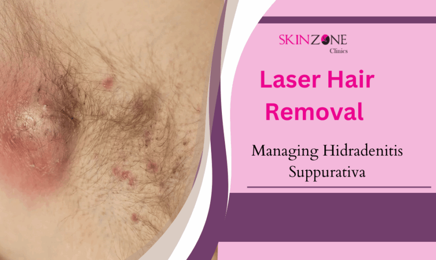 Managing Hidradenitis Suppurativa with Laser Hair Removal