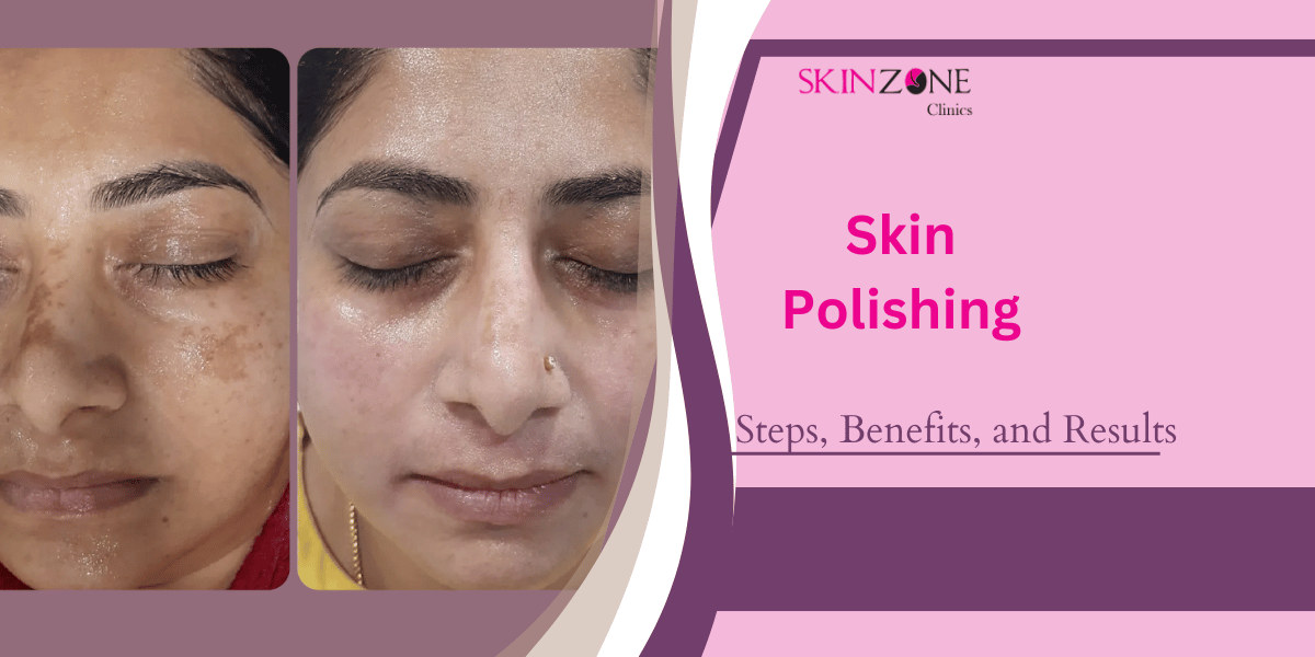 Skin Polishing Treatment Explained: Steps, Benefits, and Results