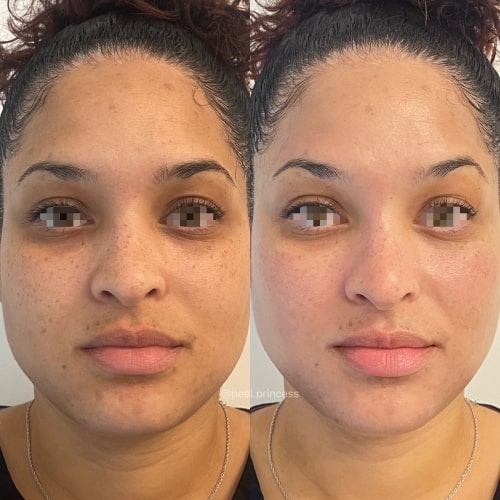 HydraFacial – A Deep Cleanse for Radiance