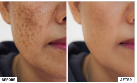 Benefits of Q-Switch Laser Treatment