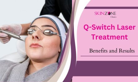What Is Q-Switch Laser Treatment? Discover the Benefits and Results