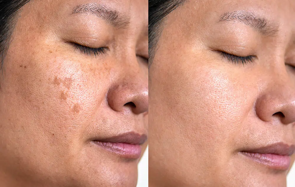 How Does Q-Switch Laser Treatment Work?