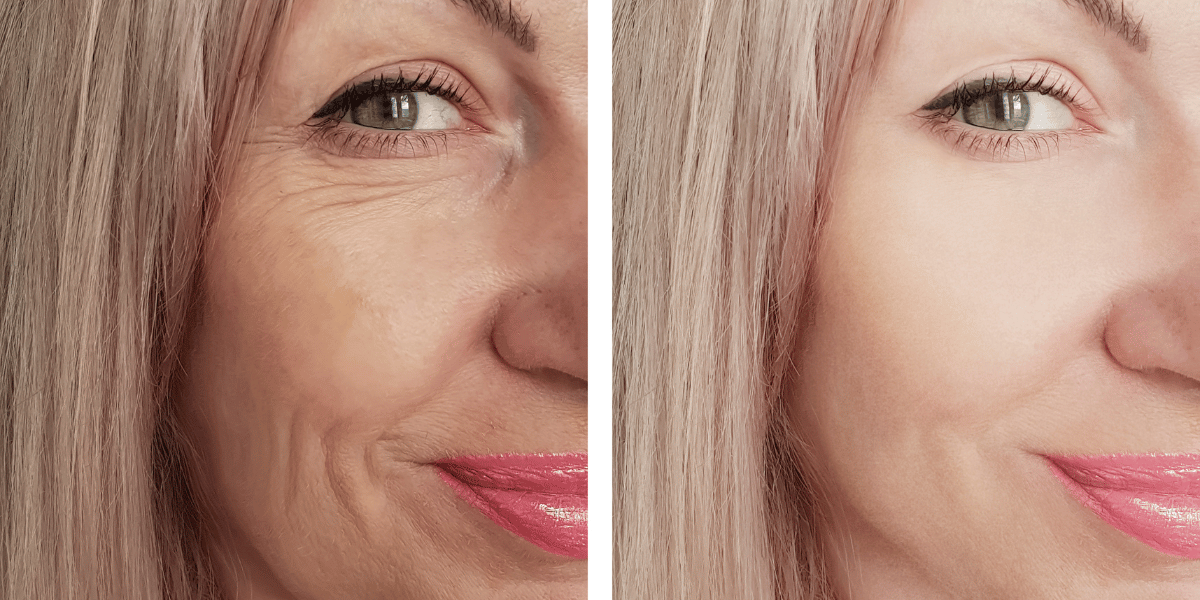 Botox Treatment for Wrinkles