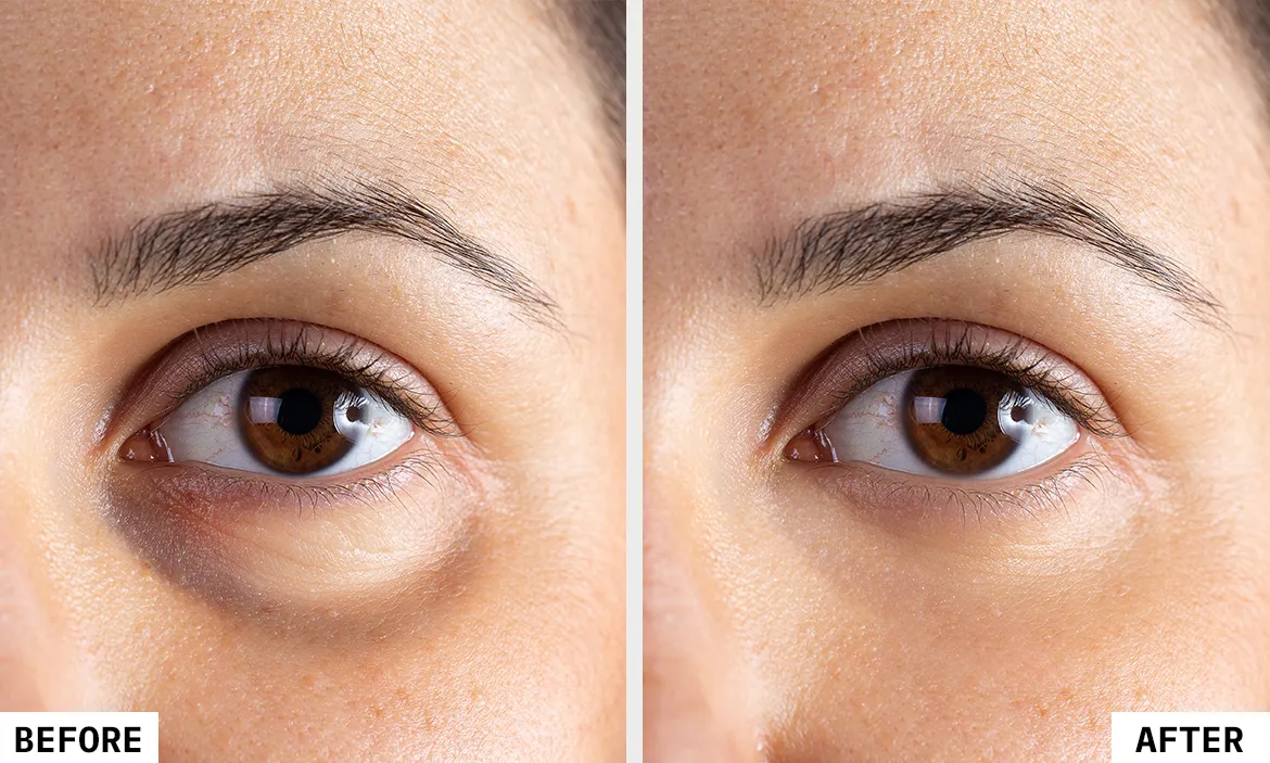 Cost of Derma Fillers in Mumbai