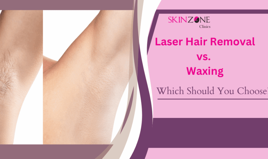 Laser Hair Removal vs. Waxing: Which One Should You Choose?