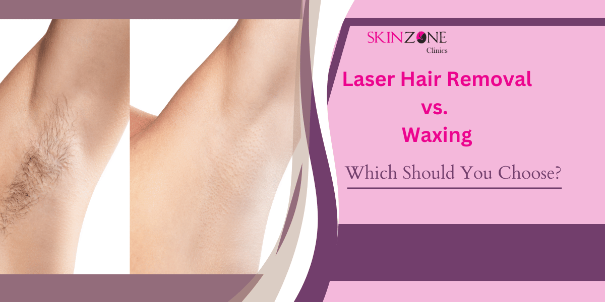 Laser Hair Removal vs. Waxing: Which One Should You Choose?