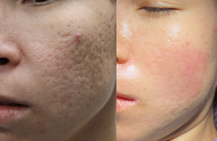 The Importance of Acne Scar Treatment