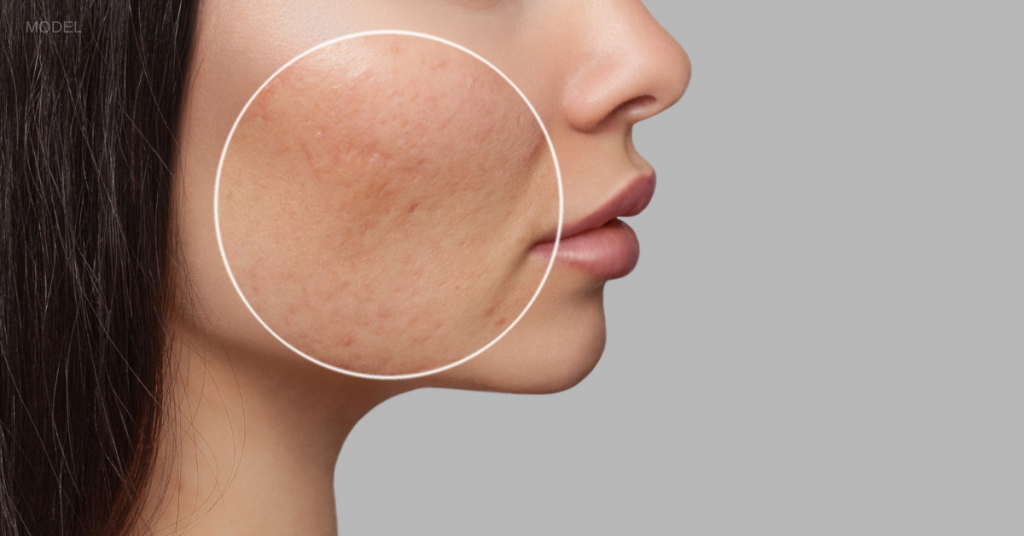 Effective Treatments for Acne Scars