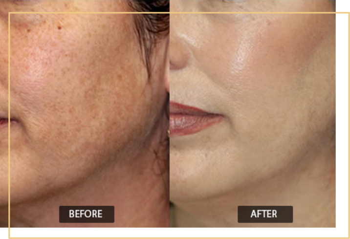 Laser Toning Treatment In Mumbai