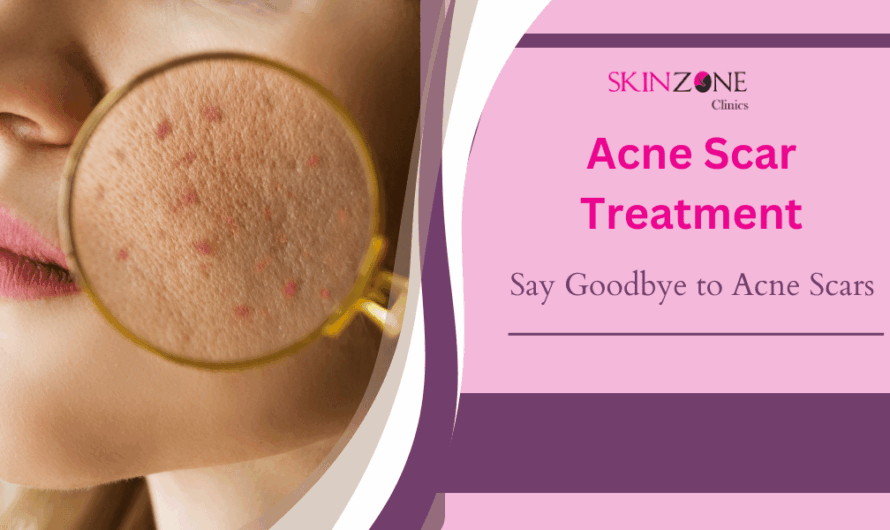 Say Goodbye to Acne Scars: Top Treatments for Smooth, Clear Skin