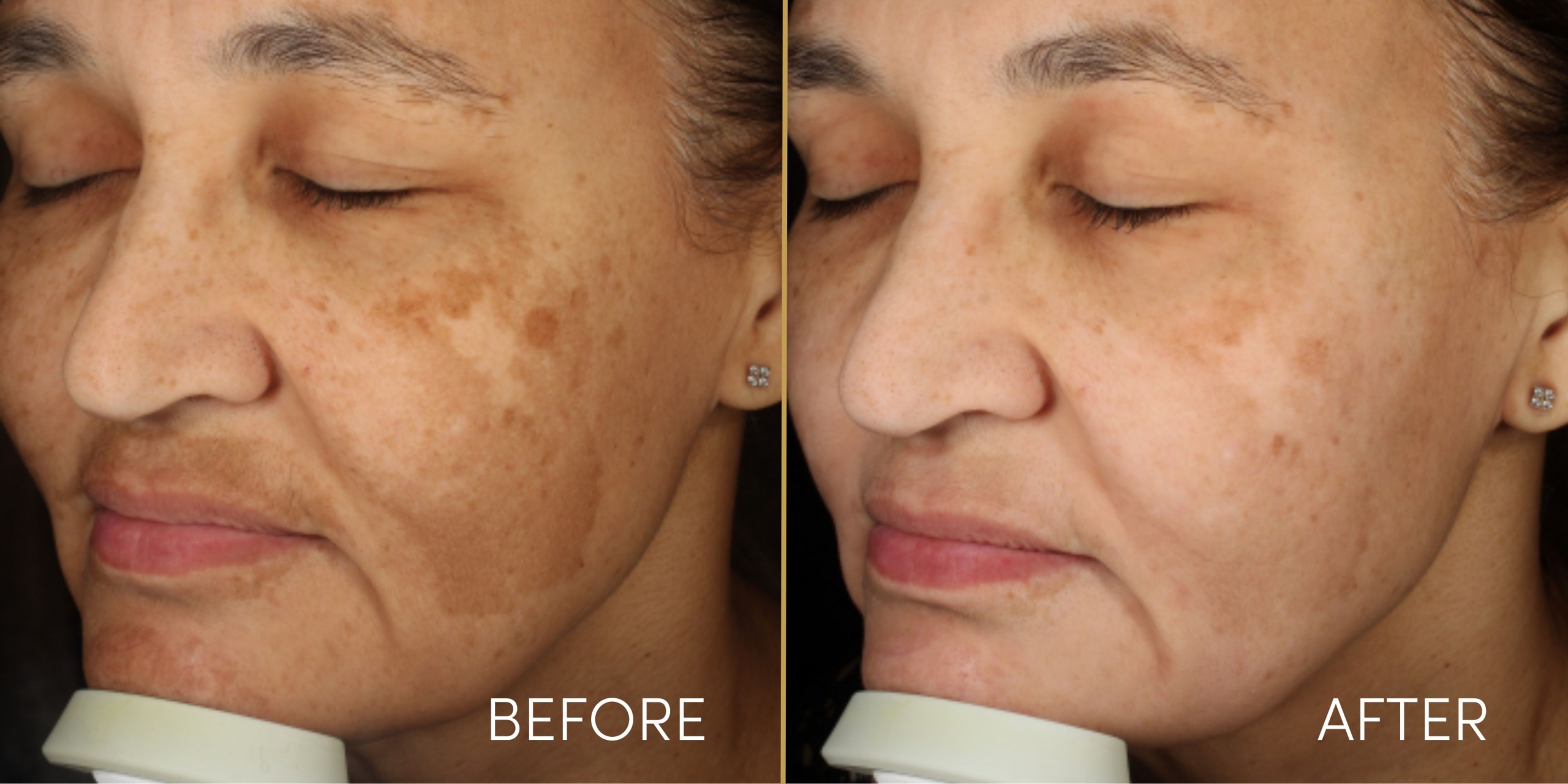 Personalized Treatments for Skin Pigmentation