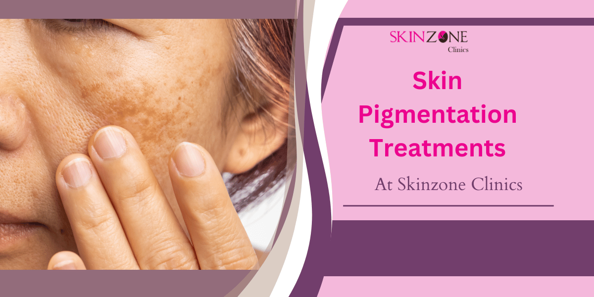 Personalized Skin Pigmentation Treatments for Better Results at Skinzone Clinics