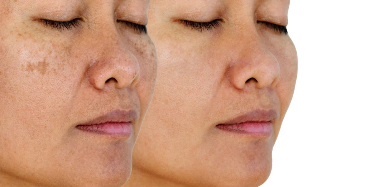 Skin Pigmentation Treatments