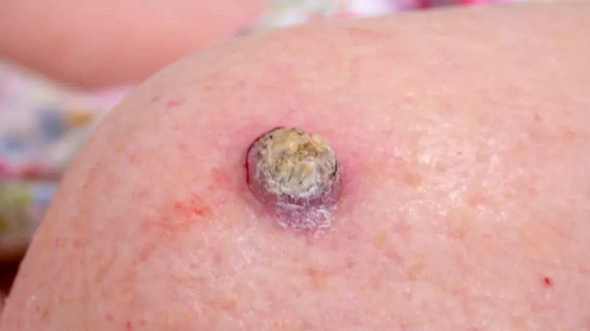 Why Skin Cancer Awareness Matters