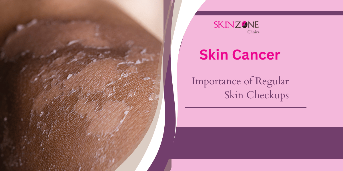 The Importance of Regular Skin Checkups: Preventing Skin Cancer