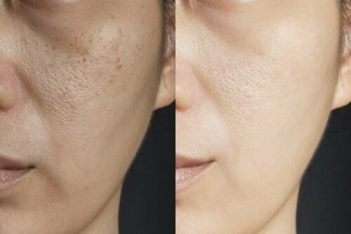 Chemical Peels for Pigmentation and Tan