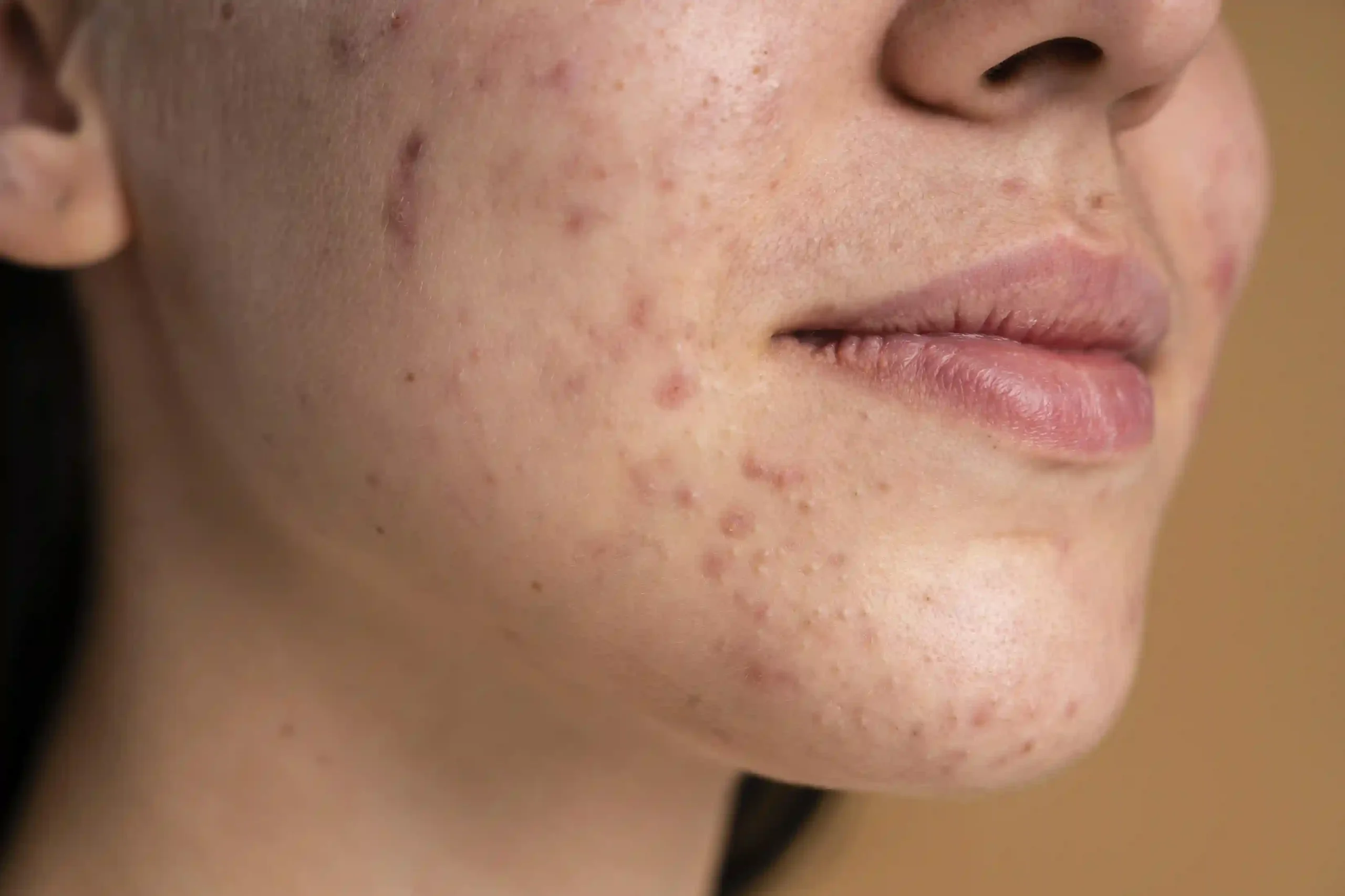 What Makes Acne-Prone Skin Hard to Manage?
