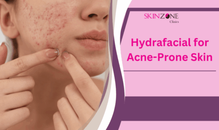 Hydrafacial for Acne-Prone Skin: Does It Really Help?