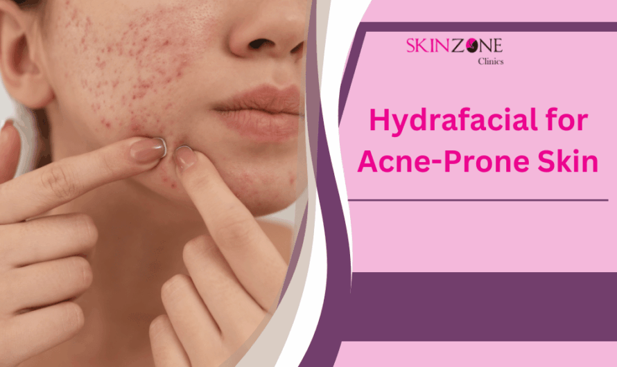 Hydrafacial for Acne-Prone Skin: Does It Really Help?
