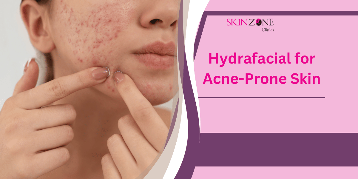 Hydrafacial for Acne-Prone Skin: Does It Really Help?