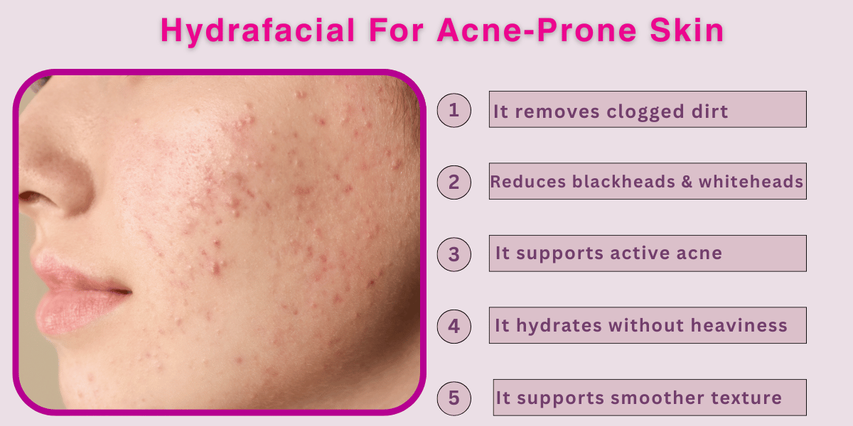 Hydrafacial For Acne-Prone Skin