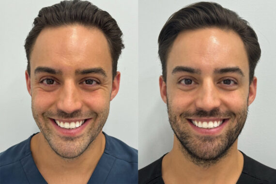 What Affects How Long Botox Lasts?