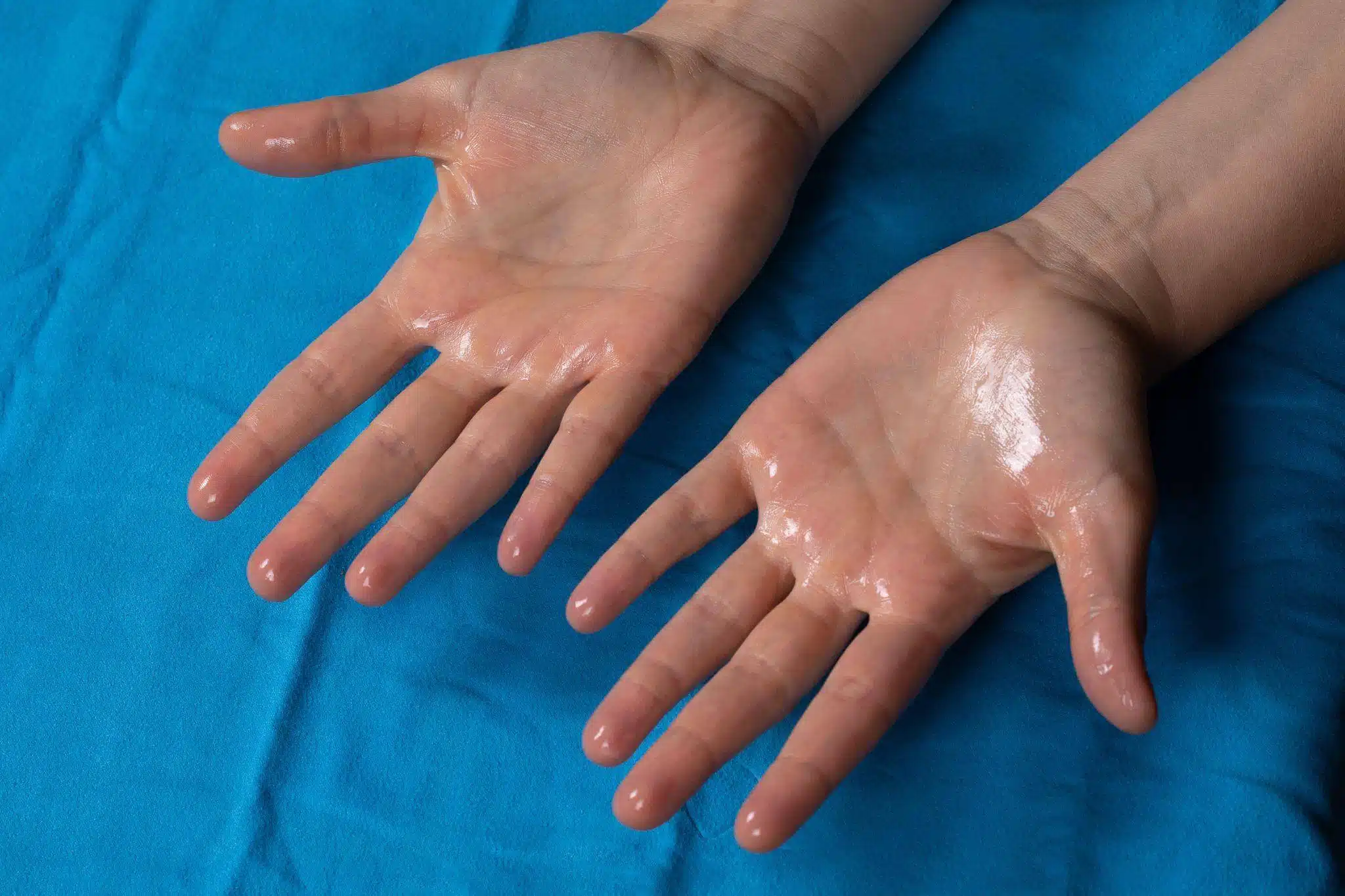 What is Hyperhidrosis?