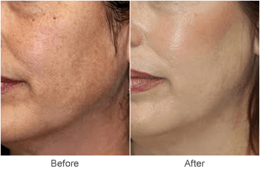 Laser Skin Resurfacing: Erase the Years