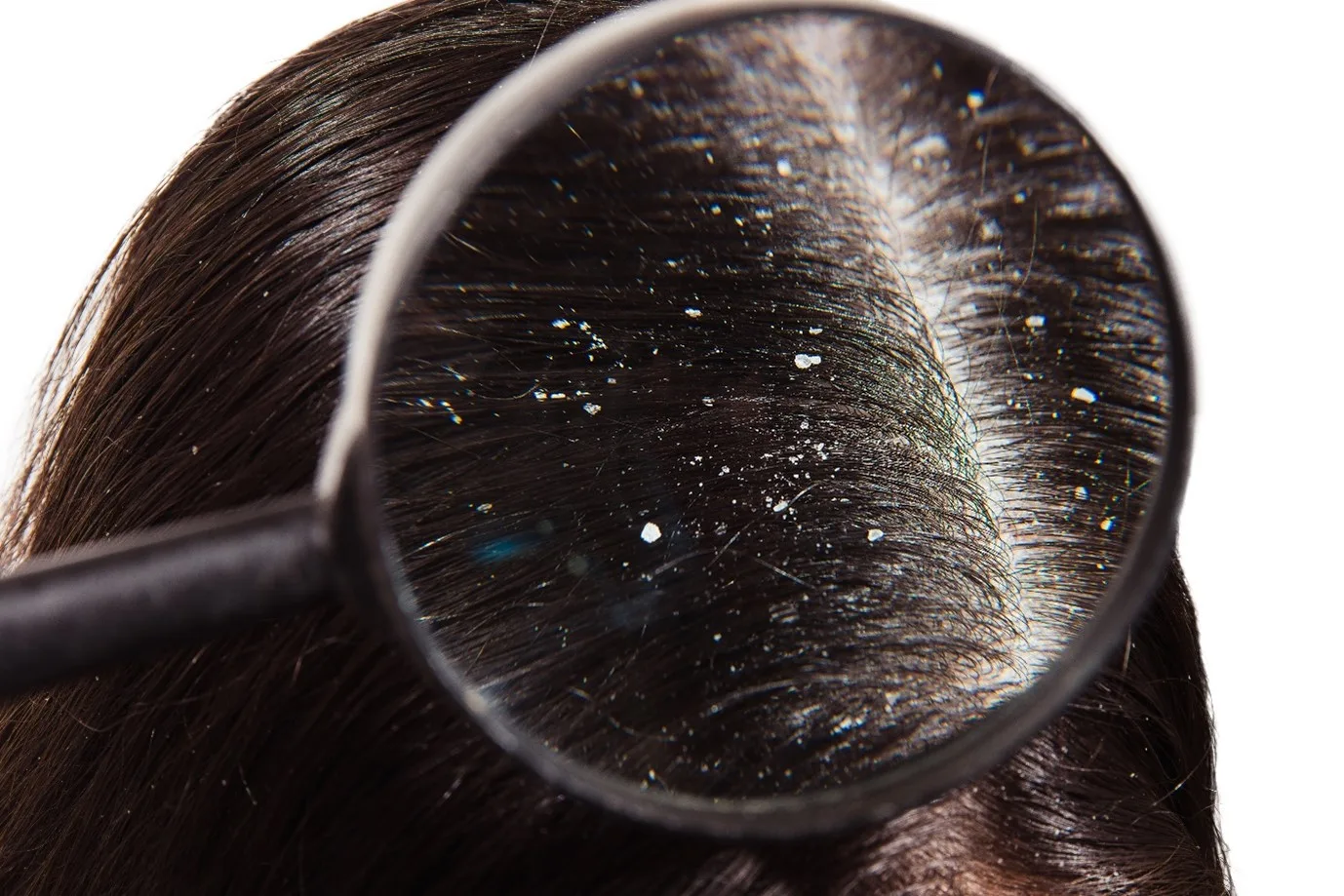 Understanding Dandruff: What Causes It?