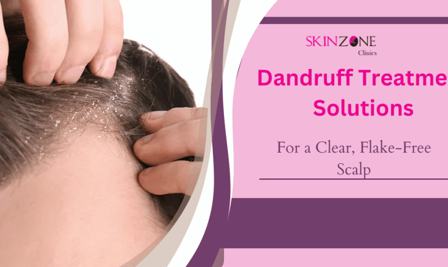 Top Dandruff Treatment Solutions for a Clear, Flake-Free Scalp