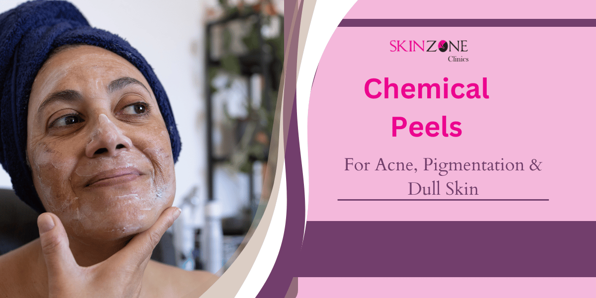Chemical Peels for Acne, Pigmentation & Dull Skin: The Modern Dermatology Secret