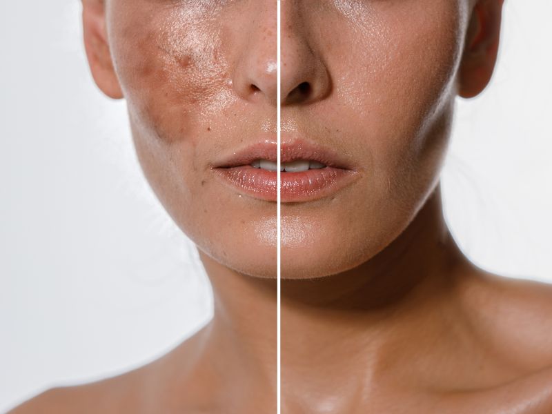 What Are Chemical Peels?